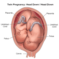 Illustration of a twin birth, head down/head down