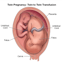 Illustration of a twin birth, twin to twin transfusion 