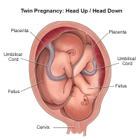 Illustration of a twin birth, head up/head down