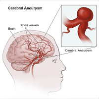 Illustration of cerebral aneurysm