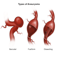 Illustration of types of cerebral aneurysm