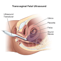Illustration of a Vaginal Ultrasound