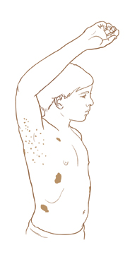 Outline of teen boy with right arm raised, seen from the side. Small brown spots are in boy's armpit. Three large brown spots are on boy's chest and abdomen.
