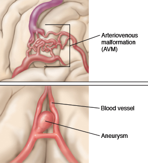 Closeup view of arteriovenous malformation (AVM) in the brain. Closeup view of aneurysm in the brain.