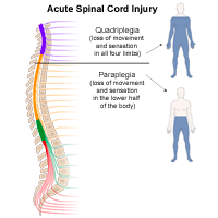 Illustration of acute spinal cord injuries that would result either in quadriplegia or paraplegia