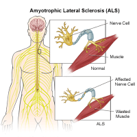 Illustration of amyotrophic lateral sclerosis