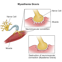 Illustration of myastenia gravis