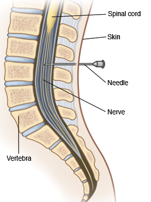 Side view of cross section of lower spine showing spinal cord in vertebrae. Nerves come off end of spinal cord and continue down back inside spine. Needle goes through skin and into space between nerves.