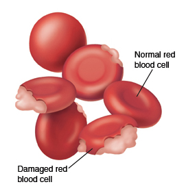 Disk-shaped normal red blood cell. One red blood cell is spherical. Four red blood cells are damaged and breaking down.