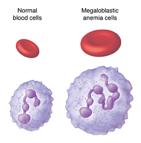 Normal disk-shaped red blood cell and spherical white blood cell. Next to these are much larger red blood cell and white blood cell with megaloblastic anemia.