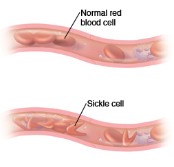 Cross section of vessel showing normal blood cells. Cross section of blood vessel showing sickle cell anemia.