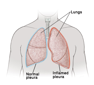 Front view of man's neck and chest showing right lung covered by normal pleura. Left lung is covered by inflamed pleura.