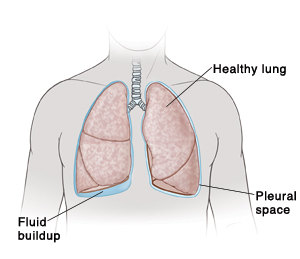Outline of man's neck and chest showing fluid buildup under right lung.