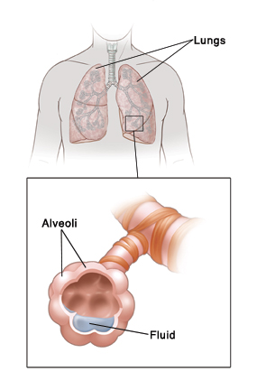 Front view of human neck and chest showing lungs. Detail of lung shows closeup view of fluid building up in alveoli.