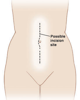 Outline of human figure with line in center of abdomen starting at top of abdomen, curving around belly button, and ending at bottom of abdomen.