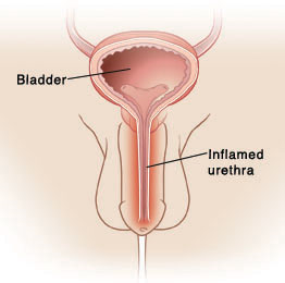 Front view of penis and scrotum. Cross section of bladder is visible just above penis with urethra going from bladder through penis to the outside. Urethra is inflamed.