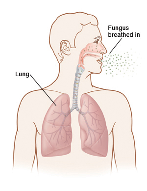 Outline of man's head and chest showing fungus being breathed into nose and lungs.