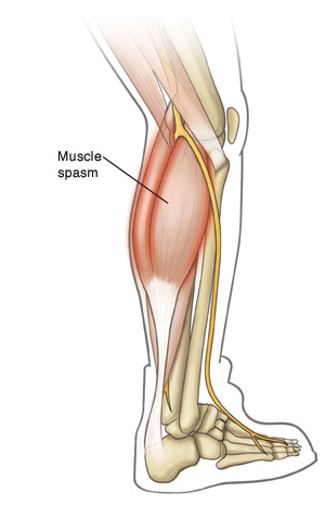 Outline of right lower leg showing calf muscles contracting in a spasm.