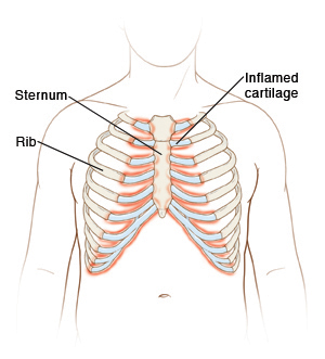 Outline of torso showing ribcage. Cartilage connects ribs to sternum in center of chest. Cartilage is inflamed.