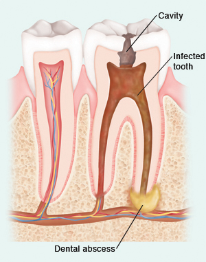 Cross section of two teeth in jawbone. Inside root of healthy tooth is space containing blood vessels and nerves. Cavity in top of unhealthy tooth has caused infection inside tooth. Dental abscess has formed at bottom of tooth root and in bone next to infected root.