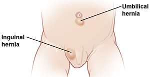 Lower abdomen of male baby showing lump in scrotum where there is inguinal hernia, and lump under belly button where there is umbilical hernia.