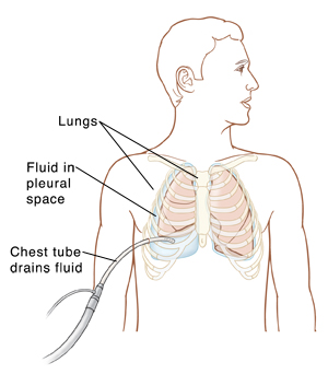 Outline of man showing fluid trapped between collapsed lung and body wall on right side. Normal lung on left. Tube inserted into chest between ribs on right is removing trapped fluid.