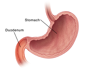 Cross section of stomach and duodenum. Duodenum is inflamed.