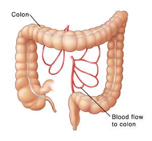 Ischemic Colitis