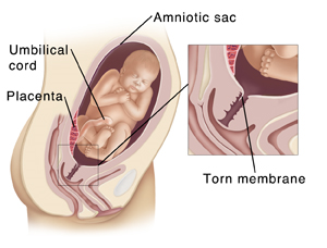 Cross section of pregnant woman's pelvis showing baby developing in amniotic sac in uterus. Placenta is attached to inside of uterus. Placenta is attached to baby by umbilical cord. Closeup detail shows tear in amniotic sac.