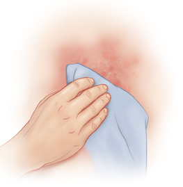 Hand with cloth patting red, irritated skin dry.