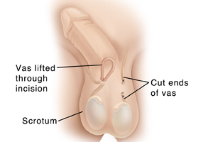 Penis and scrotum with penis pointing up to show underside. Testicles visible in scrotum. Vas on left side is cut and tied above testicle. Loop of vas on right has been brought out through small puncture.