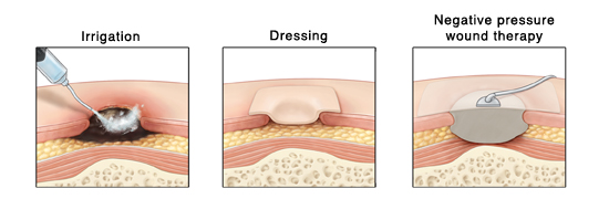 Cross section of skin showing three pressure ulcers. One is being treated with irrigation, one with a moisture dressing, and one with negative pressure wound therapy.