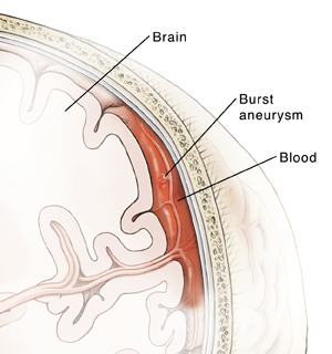 Cross section of brain in skull showing burst aneurysm in blood vessel on surface of brain. Vessel is bleeding into space between brain and skull.