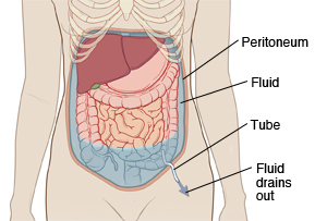 Outline of woman's abdomen showing abdominal organs. Abdominal wall is lined on inside with peritoneum. Fluid is filling abdomen under peritoneum and around organs. Tube is inserted through skin into abdomen to drain fluid out.