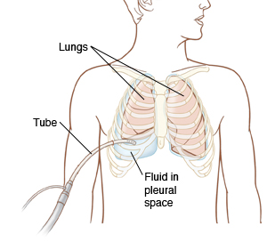 Front view of man's chest showing tube draining fluid from space next to lung.