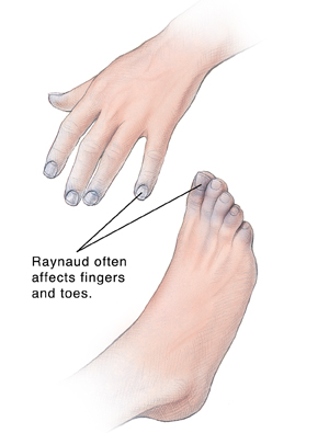 Hand and foot showing discolored tips of fingers and toes. Raynaud often affects fingers and toes.