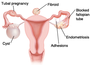 Illustration showing a cyst, a tubal pregnancy, a fibroid, a blocked fallopian tube, endometriosis, and adhesions of the female reproductive system