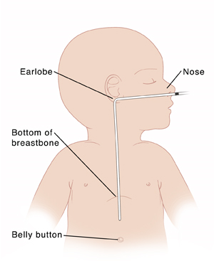 Side view of outline of a baby showing a nasogastric tube measured from nose to earlobe, then to bottom of breastbone. 