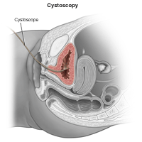 Illustration of Cystoscopy in female patient