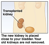 Image of kidney transplant