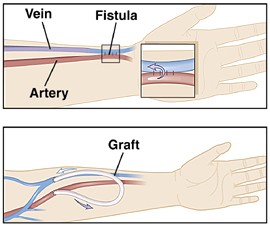 Forearm showing fistula created between artery and vein. Forearm showing graft placed between artery and vein.