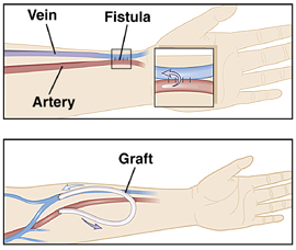 Hemodialysis Graft Hemodialysis Graft
