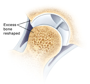 Cross section of hip joint showing excess bone reshaped from femoral head and lip of socket.