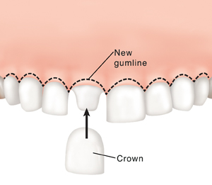 Crown being placed on shaped tooth. Dotted line shows new gumline.