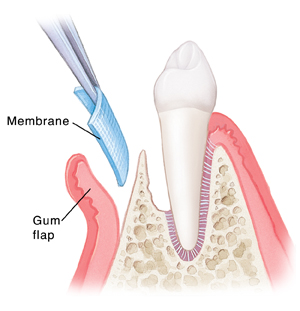 Periodontal Disease: Guided Tissue Regeneration (GTR)