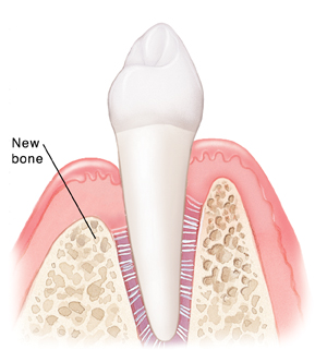 Tooth and gums after healing from tissue regeneration.