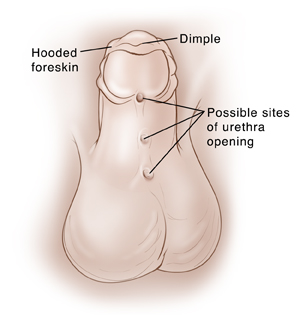 Child's penis with penis pointing up to show underside. Foreskin surrounding glans is hooded and drapes over tip of penis. Dimple in tip of penis. Three holes along underside of penis in center from glans to scrotum show possible sites of urethra opening.