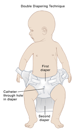 Baby lying on back with diaper on. Hole is cut in diaper over penis. Catheter comes through hole. Second diaper is being placed over first diaper and catheter.