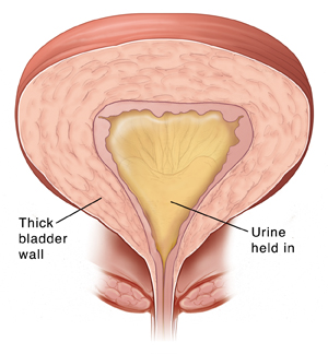 Cross section of bladder with thick wall. Urine is held in because of thickened bladder wall.
