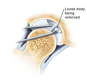 Cross section of hip joint showing arthroscopic instruments removing loose piece of tissue from joint. Closeup of arthroscope tip in hip joint and instrument removing loose body.